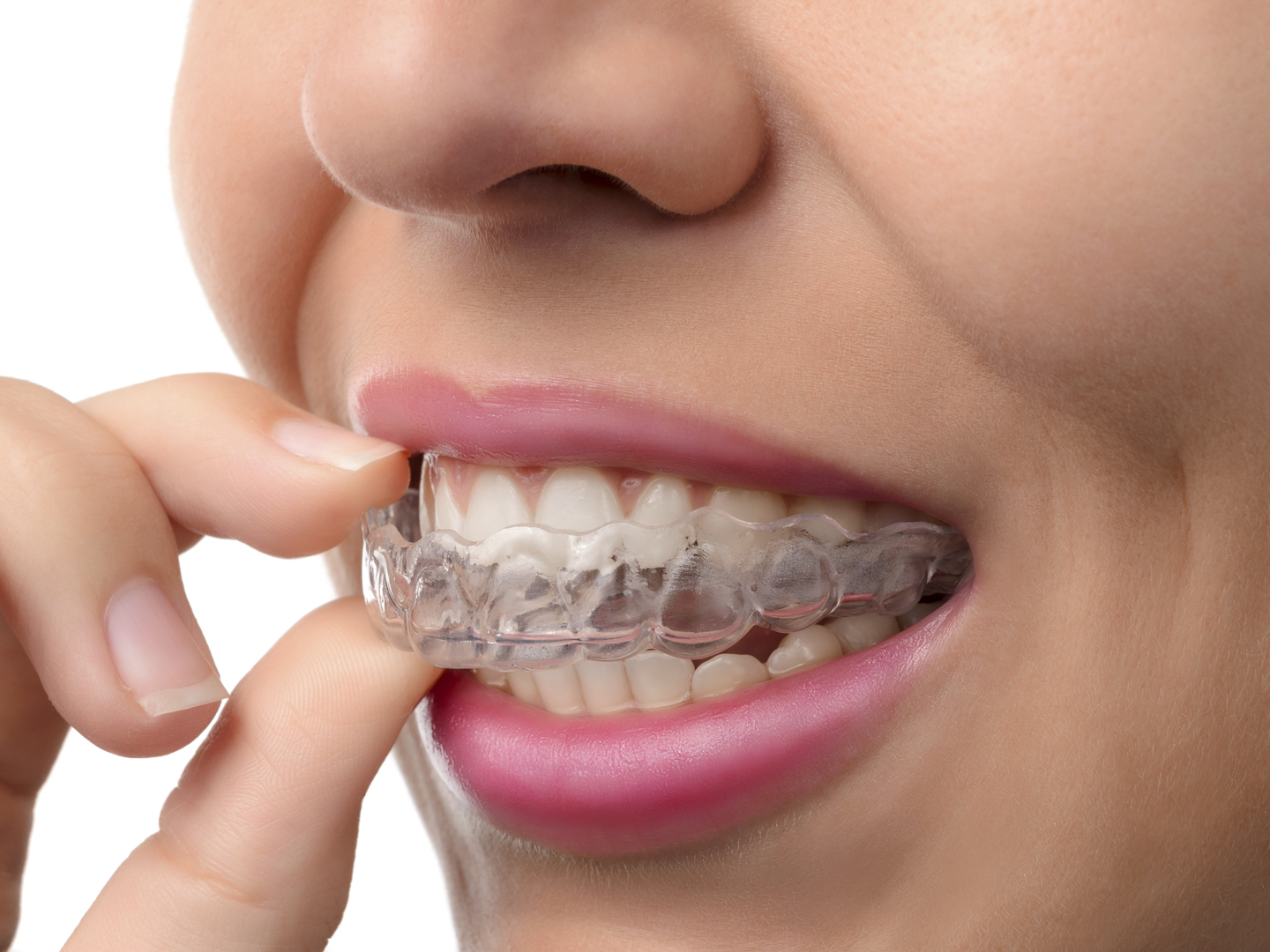 Woman wearing orthodontic silicone trainer. Invisible braces