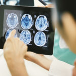 do concussions cause parkinsons