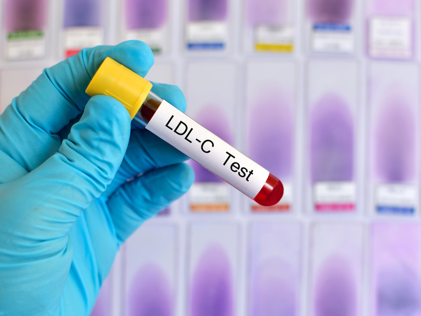 Blood sample for LDL cholesterol (LDL-C) test